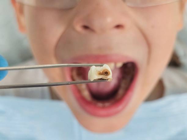 Best Chipped Tooth Repair Near Me  in Ulysses, KS